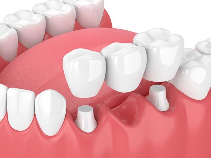 Dental-Bridge Dental-Bridge