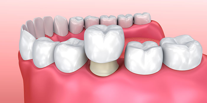Dental Crown Dental Crown
