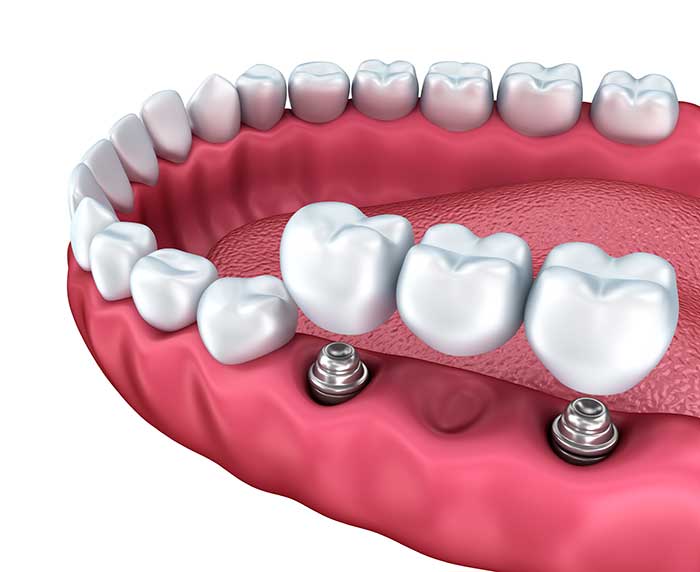 Dental-Implant-with-bridge