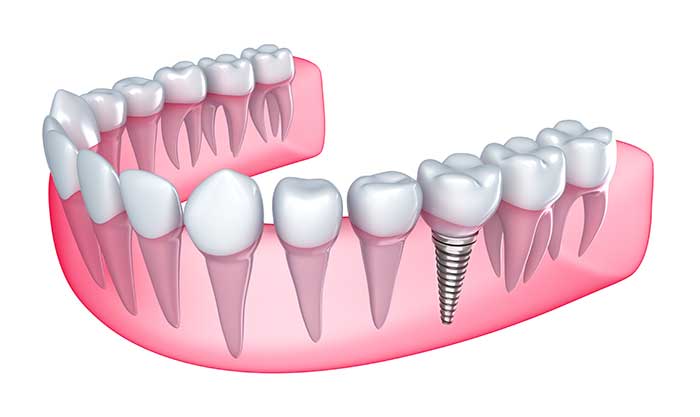 Dental-Implants