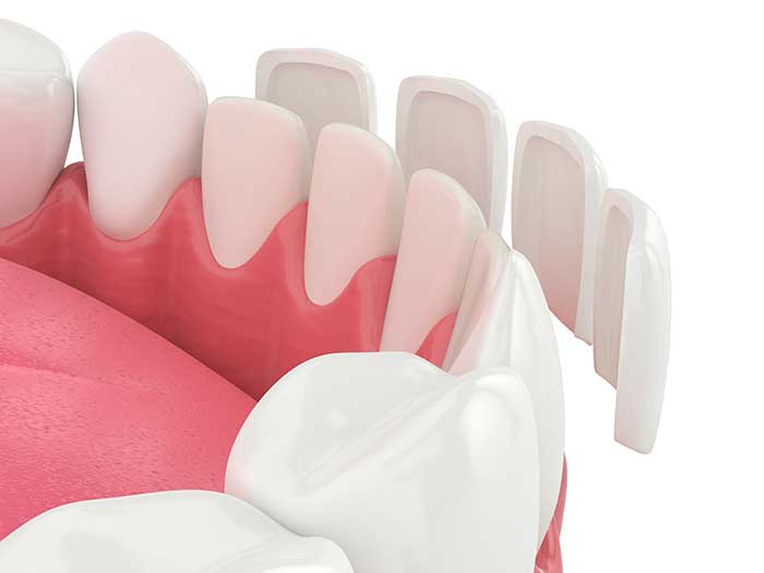 Dental-Veneers Dental-Veneers