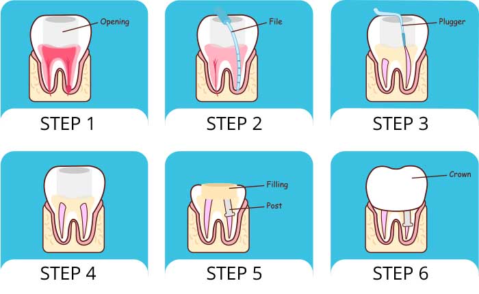 Root-Canal Root-Canal