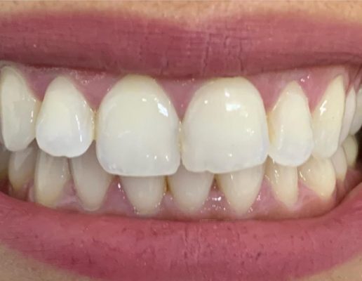 Teeth-after4-516x400
