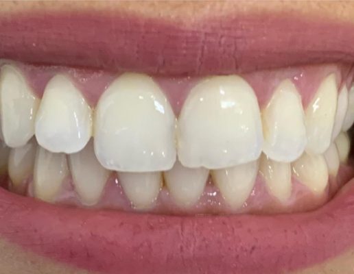 Teeth-after4-516x400 Teeth-after4-516x400