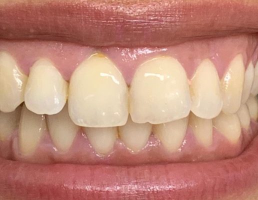 Teeth-before4-516x400