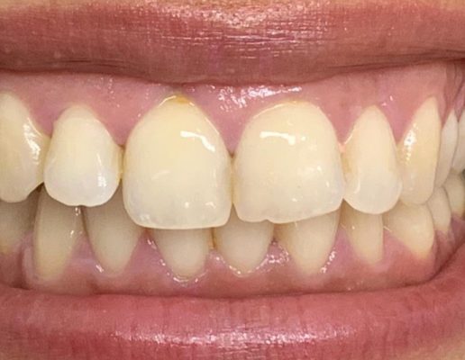 Teeth-before4-516x400 Teeth-before4-516x400