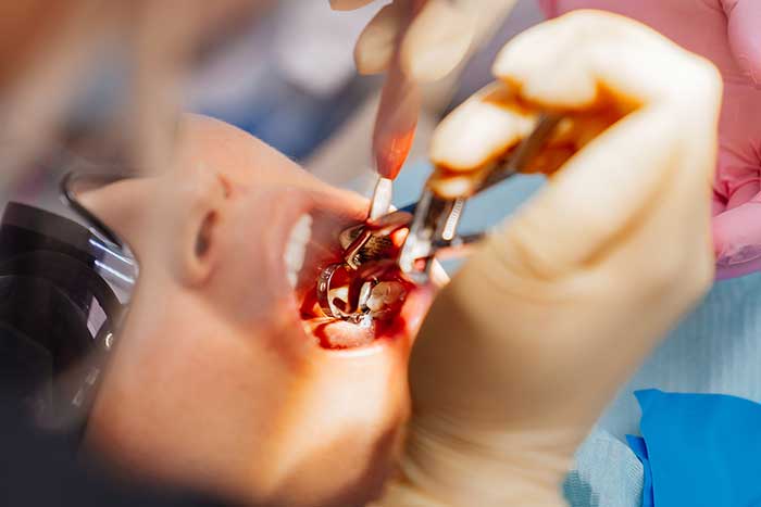 Wisdom-Tooth-Extraction Wisdom-Tooth-Extraction
