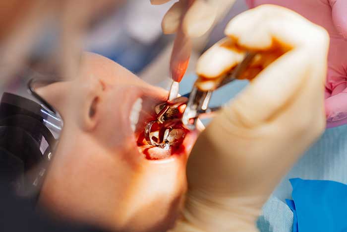 Wisdom-Tooth-Extraction